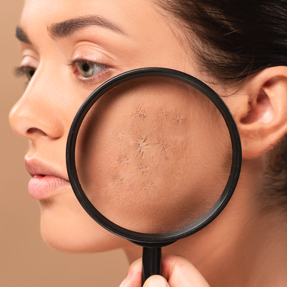 Hyperpigmentation